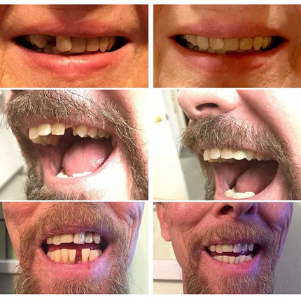 Flex Comfort Fit Temporary Teeth Replacement Top Repair Kit